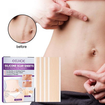 EELHOE silicone scar patch to reduce scars, stretch marks, burns, caesarean section surgery scars, hyperplasia scars, scar care