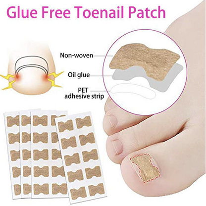 [Pack of 5] Glue-free nail correction patch, nail groove ingrown toenail corrector, toenail patch, nail patch, nail care