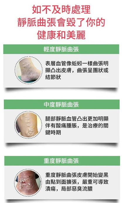 Vein massage varicose veins varicose veins leg bulging veins calf swelling earthworm legs leg varicose veins varicose veins ointment muscle soreness massage cream