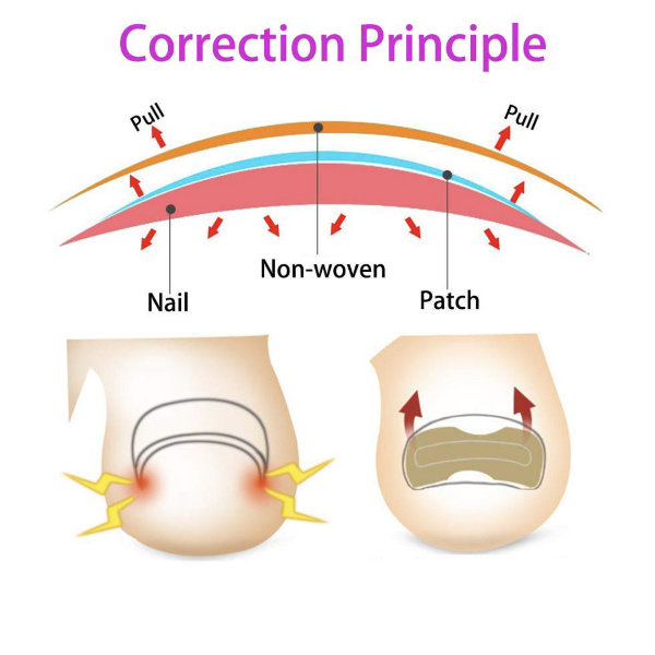 [Pack of 5] Glue-free nail correction patch, nail groove ingrown toenail corrector, toenail patch, nail patch, nail care