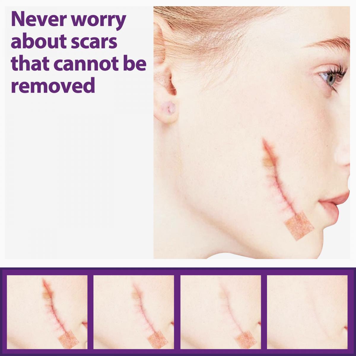 EELHOE 矽胶疤痕贴淡化伤疤妊娠纹烫伤剖腹产手术伤疤增生疤痕疤痕护理