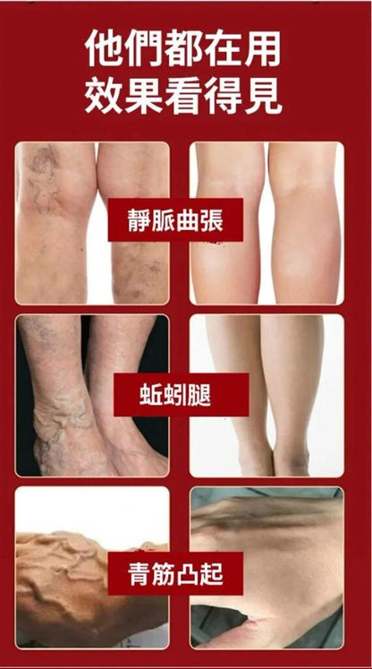 Vein massage varicose veins varicose veins leg bulging veins calf swelling earthworm legs leg varicose veins varicose veins ointment muscle soreness massage cream