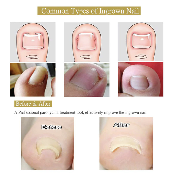 [Pack of 5] Glue-free nail correction patch, nail groove ingrown toenail corrector, toenail patch, nail patch, nail care