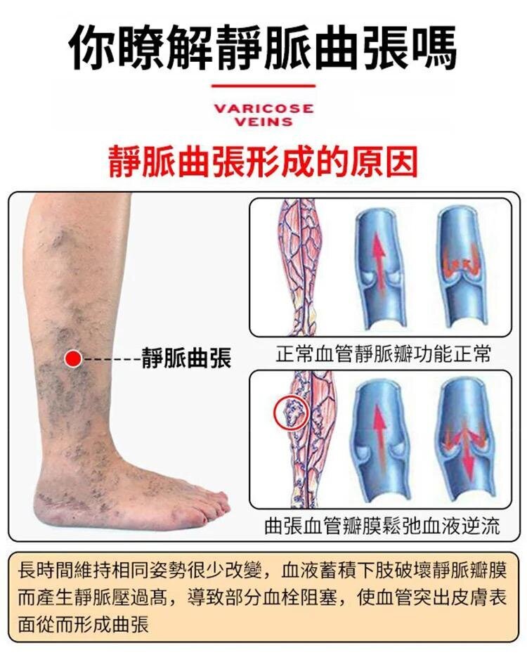 Vein massage varicose veins varicose veins leg bulging veins calf swelling earthworm legs leg varicose veins varicose veins ointment muscle soreness massage cream